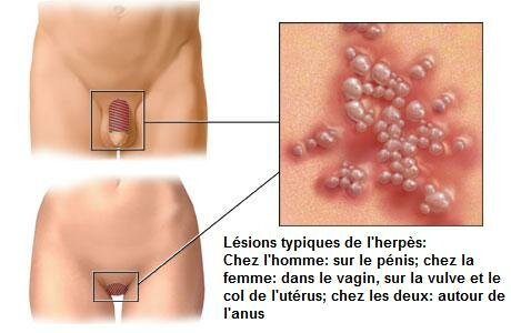 HPV