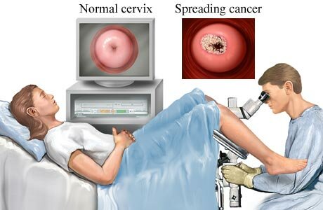 pap test