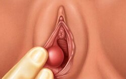 BARTHOLIN CYST