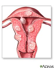 fibroids