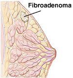 Breast Fibroadenoma