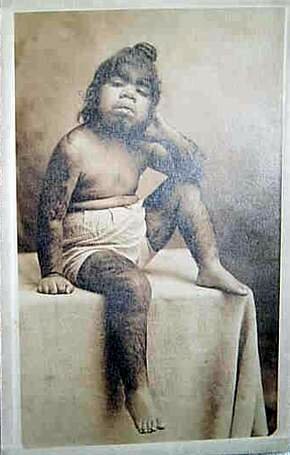 hirsutism