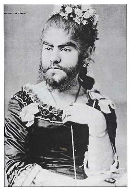hirsutism