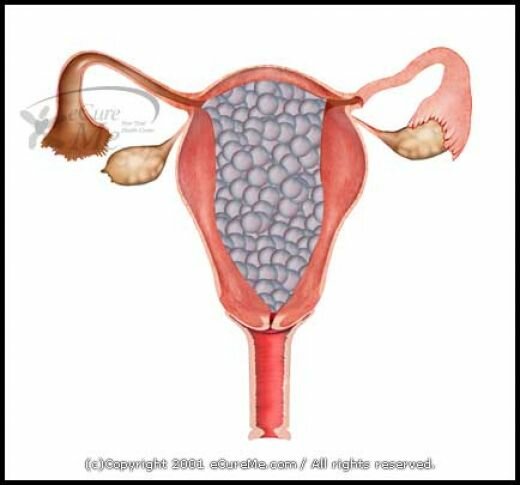 MOLAR PREGNANCY