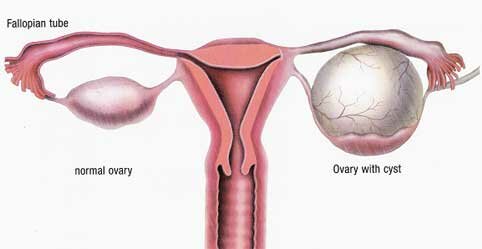 OVARIAN CYST