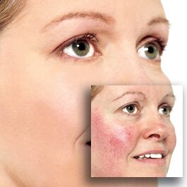 ROSACEA