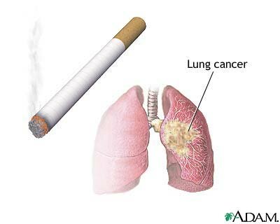 SMOKING and CANCER